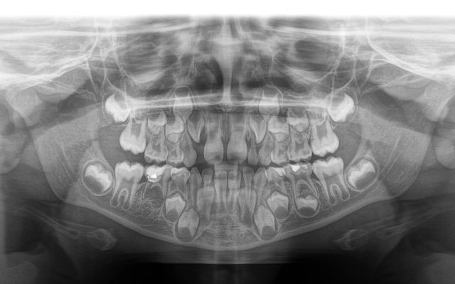 Ortopantomografia per ortodonzia - Ortopantomografia pediatrica - Dentalrad